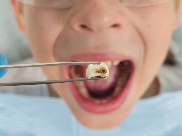 Best Emergency Treatment for Dental Infections or Abscesses in Chebanse, IL
